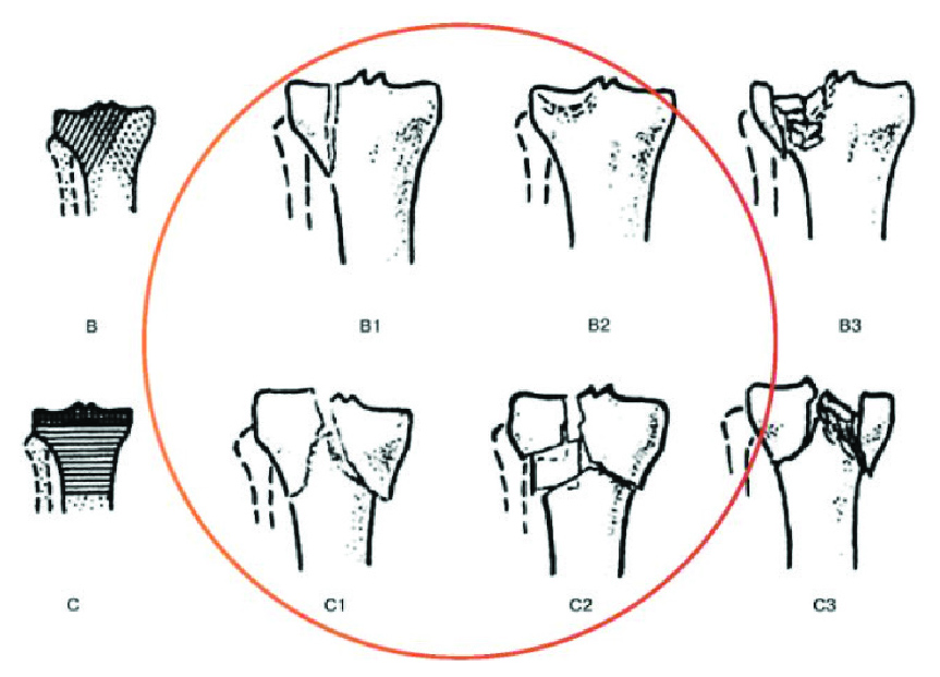 Classification of tibial plateau fractures, types B and C, with the B1 to C2 patterns treated with DIART&reg; circled